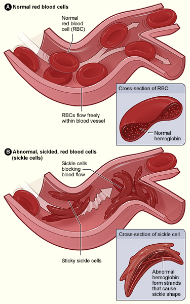 Thalassemia